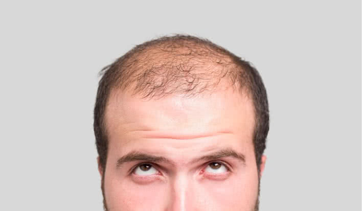 hair loss feature