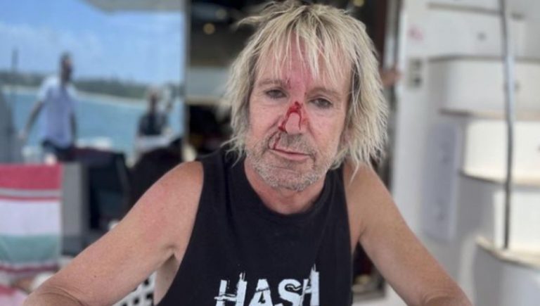 Aussie rocker has suffered a bloody face injury after partying on a yacht