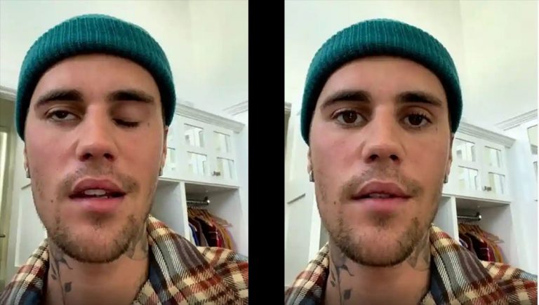 Justin Bieber reveals facial paralysis